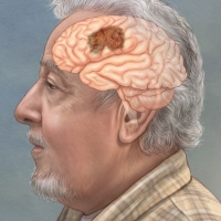 Brain Tumor