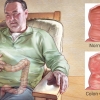 C. diff. Colitis