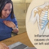 Costochondritis