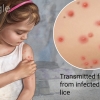 Epidemic typhus