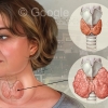 Goiter