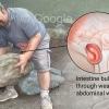 Inguinal Hernia