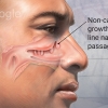 Nasal Polyps