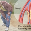 Peripheral artery disease (PAD)