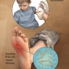 Tetanus