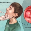 Tonsillitis
