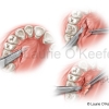 Connective Tissue Gum Graft