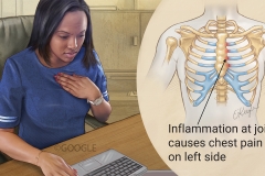 Costochondritis
