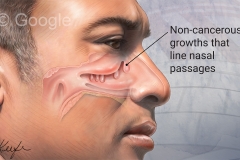 Nasal Polyps