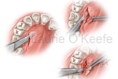 Connective Tissue Gum Graft