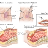 Ventral Hernia Repair
