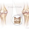 Osteoarthritis
