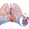 Pulmonary Edema