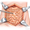 Bowel Resection