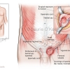Inguinal Hernia