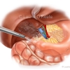 Irrigation of Bowel