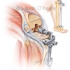 Knee Joint Replacement