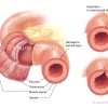 Perforation of Bowel