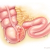 Retrocecal Appendix