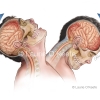 Closed head injury
