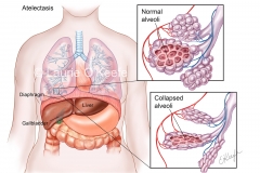 Atelectasis