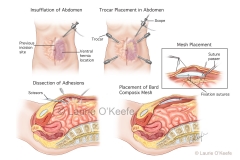 Ventral Hernia Repair