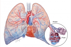 Pulmonary Edema