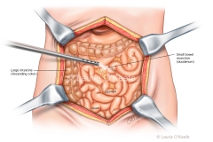Bowel Resection