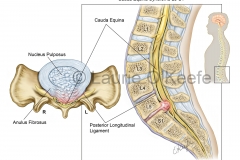 Cauda Equina Syndrome