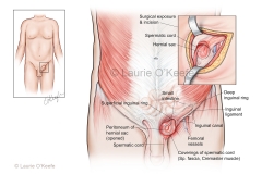 Inguinal Hernia
