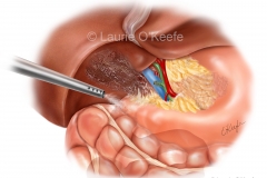 Irrigation of Bowel