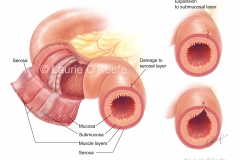 Perforation of Bowel