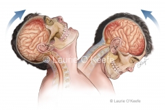 Closed head injury