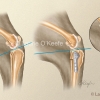 Tibeal Plateau Leveling Osteotomy-TPLO